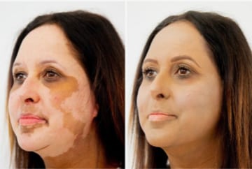 Permanentný makeup a Vitiligo